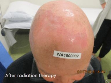 After radiation therapy